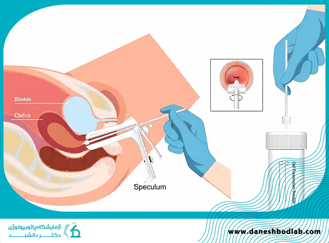 تست پاپ اسمیر در شیراز | راهنمای کامل و تفسیر جواب  